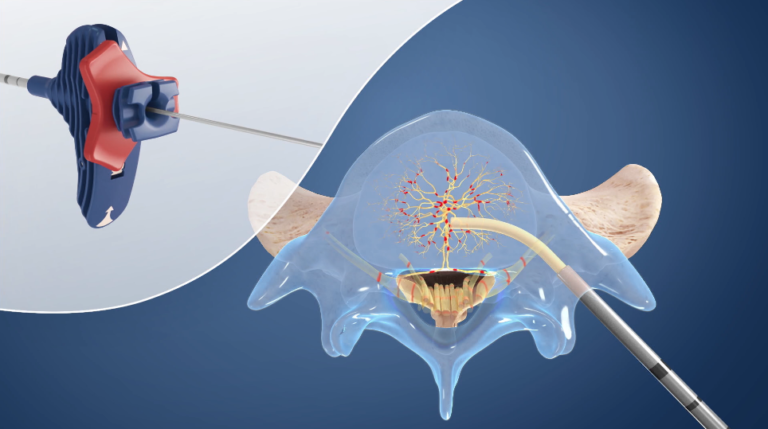 Intracept Treatment | Pain Management | Ed Rubin MD | Long Island, NY